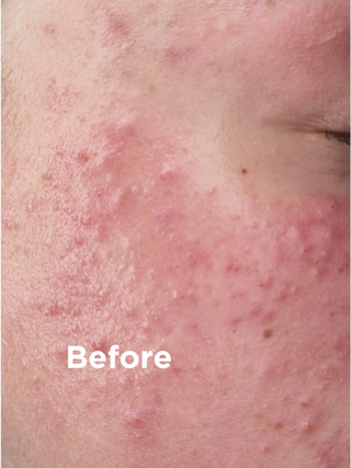 Closeup of skin before 3-Step Face Skin Health