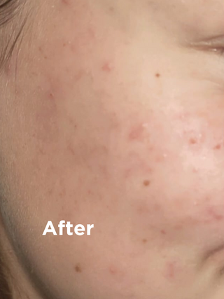 Closeup of skin after 3-Step Face Skin Health